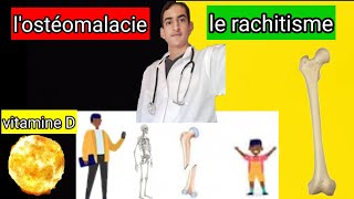 le rachitisme et lostéomalacie [upl. by Serena]