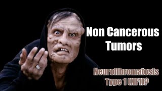 Noncancerous Tumors  What You Need to Know About Neurofibromatosis Type 1 NF1 [upl. by Niledam]