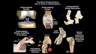 Posterolateral ACL bundle posterolateral corner Everything You Need To Know  Dr Nabil Ebraheim [upl. by Aryad]