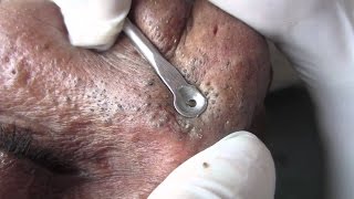 LIVE Removes blackheads  the most terrible acne in the world 2017 [upl. by Nylecaj]