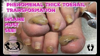 How to Pedicure Cut and Shape Thick Toenails with Nail Fungus [upl. by Salim76]