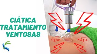 CIATICA tratamiento con VENTOSAS  Fisiolution [upl. by Thibaut]