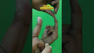 Mallet finger physiotherapy joints nerve pain anatomy stiffness movement dip pip mcp ruhs [upl. by Nath]