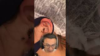 Remoção de PIERCING HELIX shorts piercing [upl. by Olegnad]