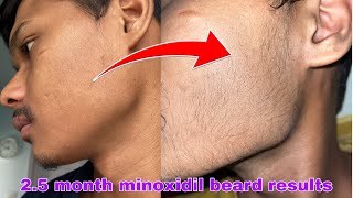 Minoxidil beard growth  2 month beard journey  transformation [upl. by Merrie]