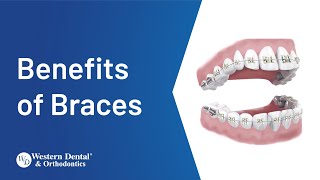 What are the Real Benefits of Braces  Western Dental [upl. by Zhang]