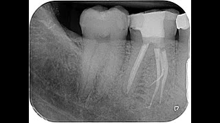 Traitement endodontique  46 5 canaux distincts anatomie mésiale folle [upl. by Dermot]