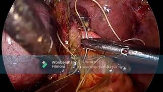 LAPAROSCOPIC CBD EXPLORATION FOR CHOLEDOCHOLITHIASIS LAST PART [upl. by Damalas]