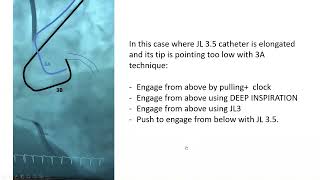 Left coronary engagement simple technique triple maneuver [upl. by Oironoh]