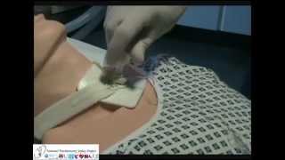 Removal of Tracheostomy Speaking Valves and Inner Tubes [upl. by Adelaide261]