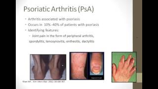 Living Well with Psoriatic Arthritis What You Need to Know [upl. by Leumek254]