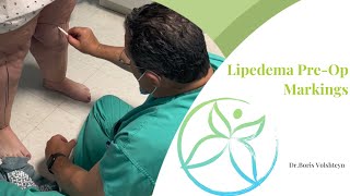 Preoperative Markings for Lipedema Liposuction  Lower Extremities  Dr Boris Volshteyn [upl. by Eiznikam]