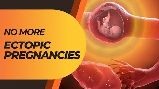 How to Avoid Ectopic Pregnancy Naturally Tips to Prevent Reoccurrence [upl. by Tatiana]