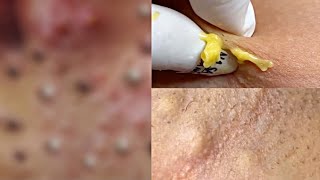 JERAWAT BATU GEDE ‼️ BIG PIMPLES [upl. by Terese542]