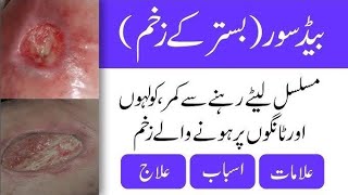 what is the Bed sore pressure sores ulcer Dr Health Officials [upl. by Moshe]