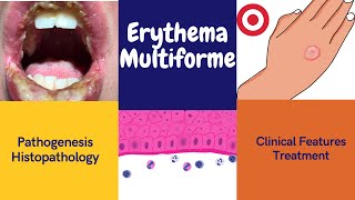 Erythema multiforme [upl. by Hashim333]