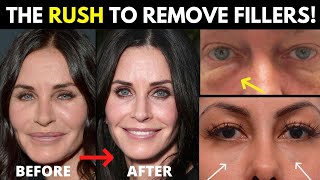 The 2022 Filler Trend Why is everyone all of a sudden dissolving their fillers [upl. by Thetisa]