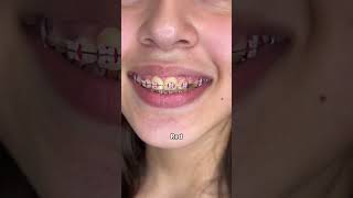 Braces Colors Before and after 8 weeks [upl. by Lad]