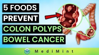 Top 5 Foods to Prevent Colon Polyps Bowel Cancer ADD Foods To Limit or Avoid  MediMint [upl. by Hgielak882]