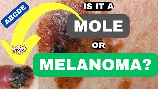 ABCDE of Melanoma Is it a Mole or Melanoma  ABCDE of Skin Cancer  Skin Cancer Symptoms and Signs [upl. by Dnalrag]