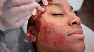 THE TRUTH ABOUT MICRONEEDLING  HOW I GOT RID OF MY ACNE SCARRING [upl. by Innavoj]