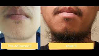 Minoxidil 3 years Update [upl. by Acirtap676]