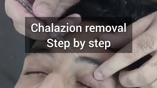 Chalazion removal 👁️ [upl. by Ylrak683]