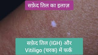 सफ़ेद तिल का इलाज़  Idiopathic Guttate Hypomelanosis IGH  सफ़ेद तिल और चरक vitiligo vitiligocure [upl. by Norved]