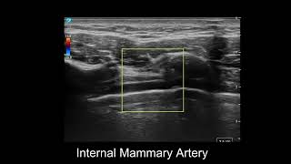 Internal Mammary Artery On Ultrasound [upl. by Tatum]