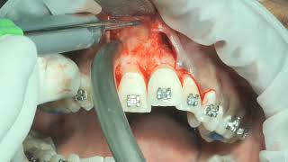 part 1 inverted and impacted  internal resorbed mesiodens surgical removal [upl. by Colier201]