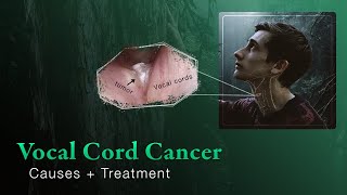 Early Vocal Cord Cancer  Introduction and Treatment Options [upl. by Sheehan658]