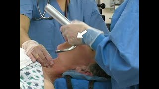 Orotracheal Intubation [upl. by Atsahs190]