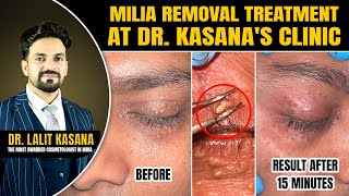 Milia Removal Treatment at DrKasanas Clinic  MILIA Removal Extraction  Before and after [upl. by Eimirej297]