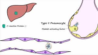 Bacterial Pneumonia  Pathogenesis [upl. by Ecam43]