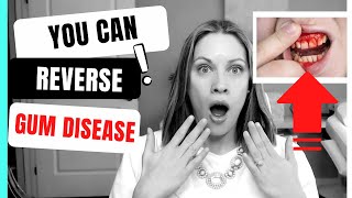 How to Reverse Gum Disease at Home [upl. by Giule384]