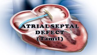 ATRIAL SEPTAL DEFECT ASDTAMIL  TYPES  HEMODYNAMICS HEART SOUND  ASD INVESTIGATION MANAGEMENT [upl. by Hooke700]