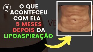 Tratamento para fibroses pós lipo e abdominoplastia Entenda o que aconteceu com ela 5 MESES depois [upl. by Gregorio]