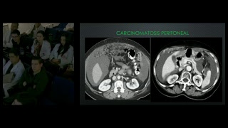 Patología Maligna de Peritoneo Mesenterio y Epiplón Dr Franklin Ordoñez Rivas [upl. by Suki]