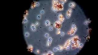 Red Blood Cell Agglutination the possible danger of blood transfusion microscopic [upl. by Intruok]