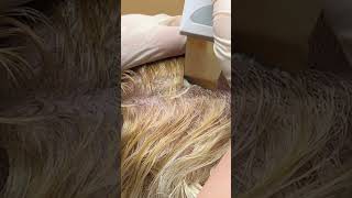 Scalp Treatment for Dandruff Removal [upl. by Ynnal]