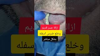 خلع ضرس اسفل جسر قديم dentist stitch اكسبلور stitchlover dentistry syria سوريا [upl. by Gader100]