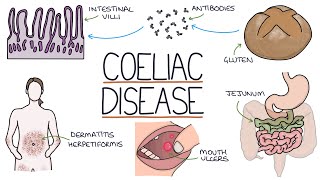 Understanding Coeliac Disease [upl. by Marks]