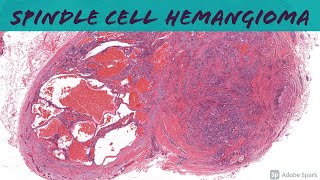 Spindle Cell Hemangioma 101 [upl. by Ytrebil230]