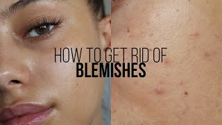 HOW TO GET RID OF BLEMISHES IN 3 DAYS  Jessicvpimentel [upl. by Ecinnaj]