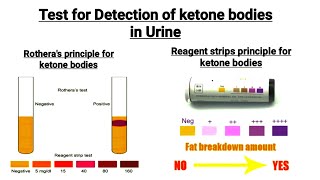 Chemical Examination of urine  Detection of ketone bodies in urine  Reagent strip  Rotheras Test [upl. by Vernita]