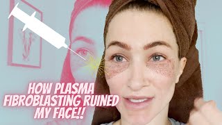 Did Plasma Fibroblast Ruin My face [upl. by Kauffman]