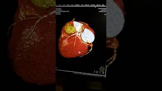 Coronary artery  medicalstudentprocessing ctscan radiology angiography medicalstudent [upl. by Ardnoel720]