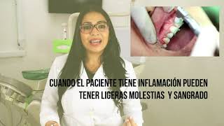 LIMPIEZA PROFUNDA EN LOS DIENTES [upl. by Ise232]