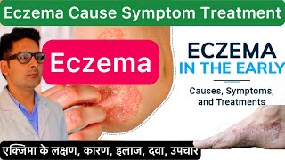 Eczema Cause Symptom Treatment  एक्जिमा के लक्षण कारण इलाज दवा उपचार बचाव  What Is Eczema [upl. by Brnaby]