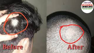 Alopecia areata treatment result in one week by Dr Salman [upl. by Woolson]